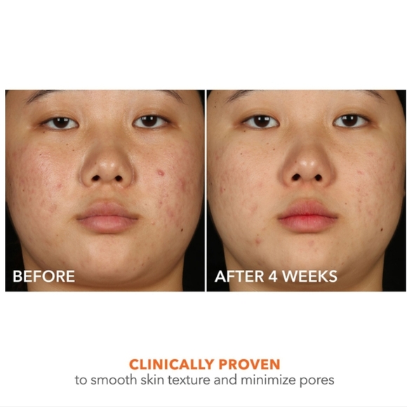 NIB DR.DENNIS GROSS ALPHA BETA 2% BREAKOUT SOLUTION - Picture 10 of 16